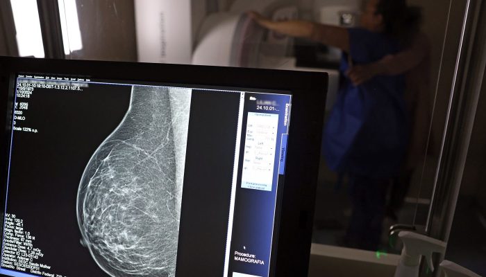 Câncer de mama: uma em cada três pacientes tem menos de 50 anos