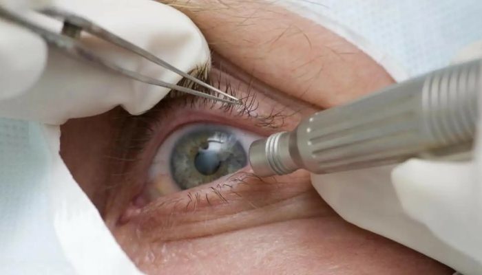 Cirurgia que altera cor do olho tem uso restrito para pessoas cegas